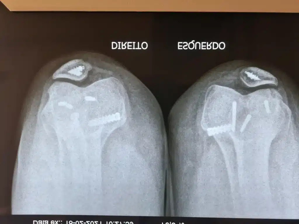 Como tratar instabilidade patelar