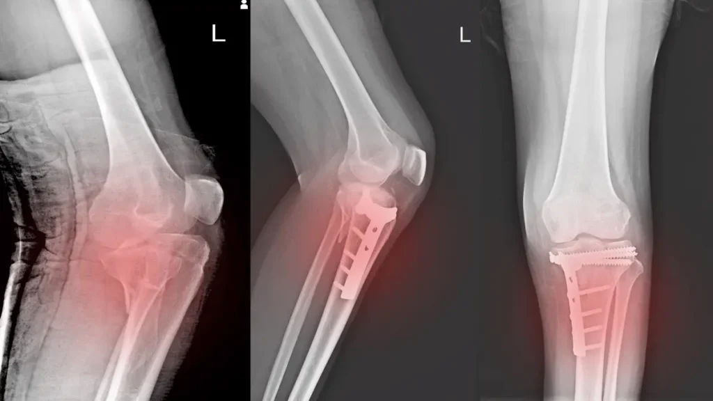 Cirurgia no fêmur é grave