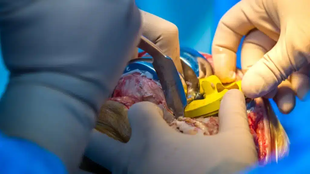 Artroplastia de Joelho a Solução Definitiva||Artroplastia de Joelho