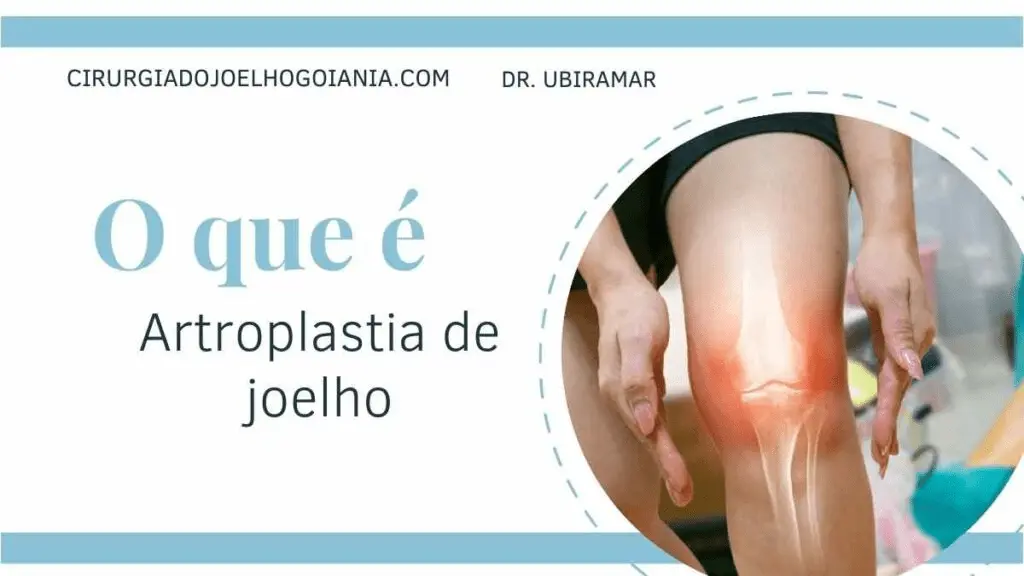 Artroplastia de joelho|Artroplastia de joelho