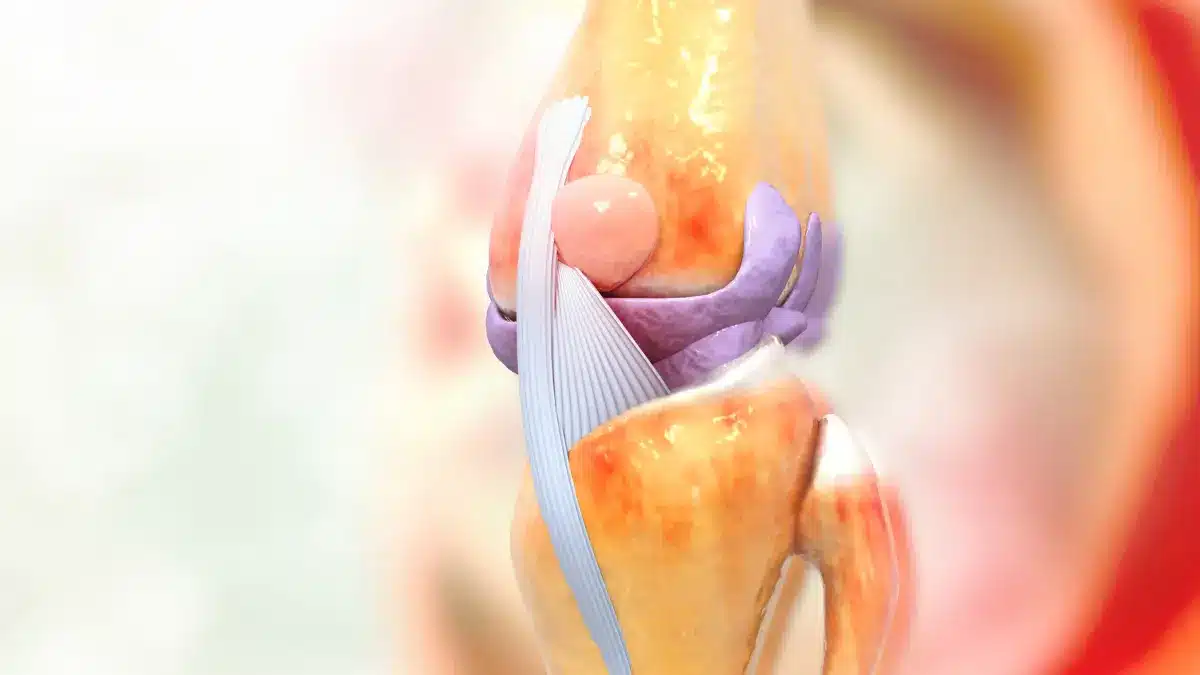 |Hiperextensão do joelho