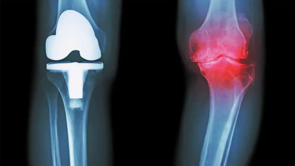 Prótese de joelho dói muito?