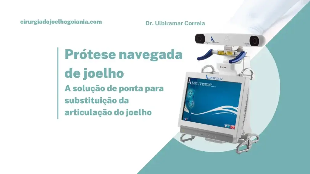 Prótese navegada de joelho||Equipamento prótese navegada de joelho|Cirurgia prótese navegada de joelho|Tela equipamento prótese navegada de joelho|Dr. Ulbiramar Correia cirurgião prótese navegada de joelho|