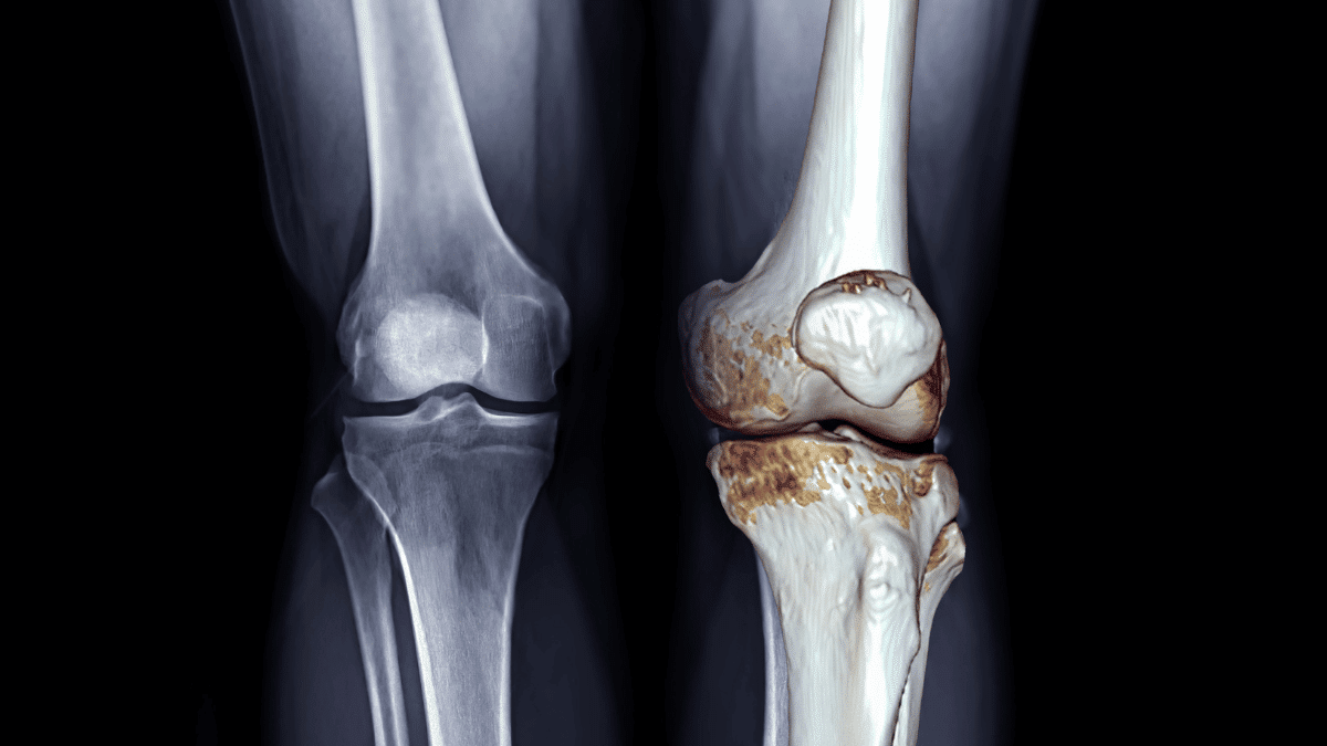 Remédio para desgaste no joelho o que funciona