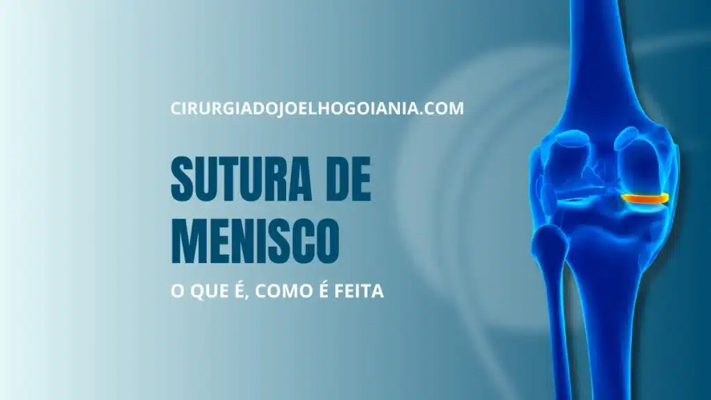 Sutura de Menisco|Sutura de Menisco