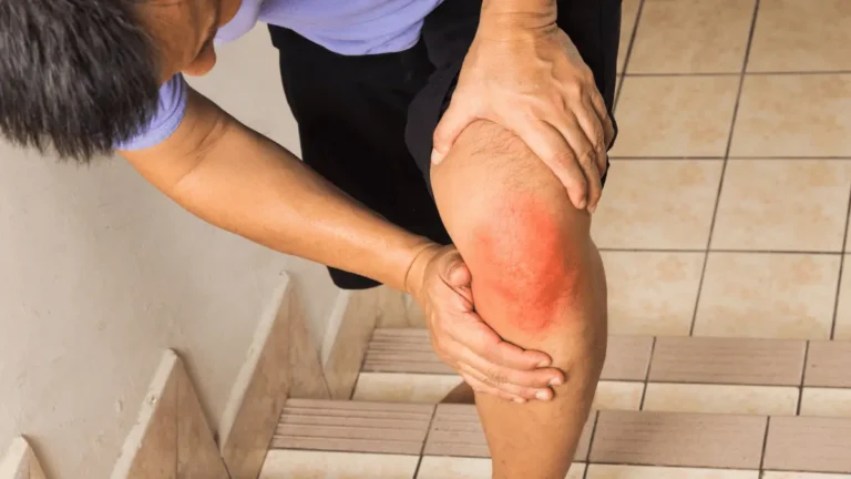 Condromalácia patelar grau 4