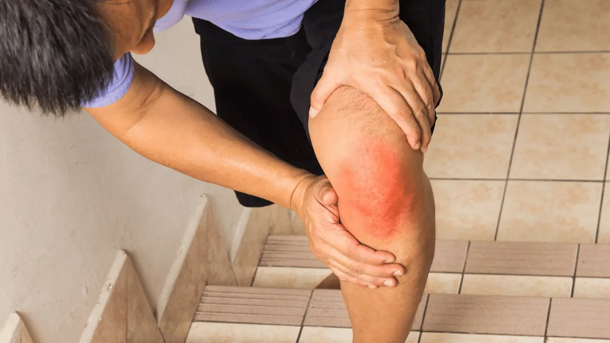 Condromalácia patelar grau 4