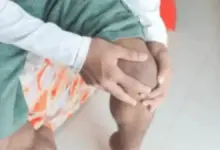 Condropatia patelar grau 3