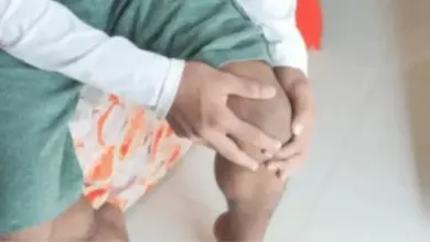 Condropatia patelar grau 3