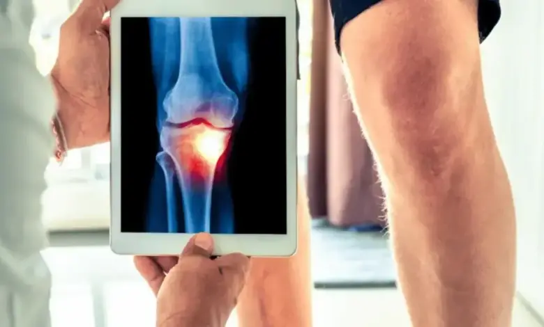 Edema no joelho é grave