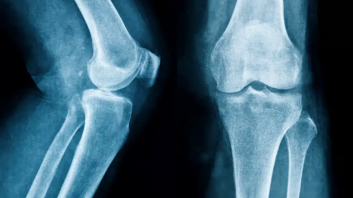 Joelho quebrado volta ao normal