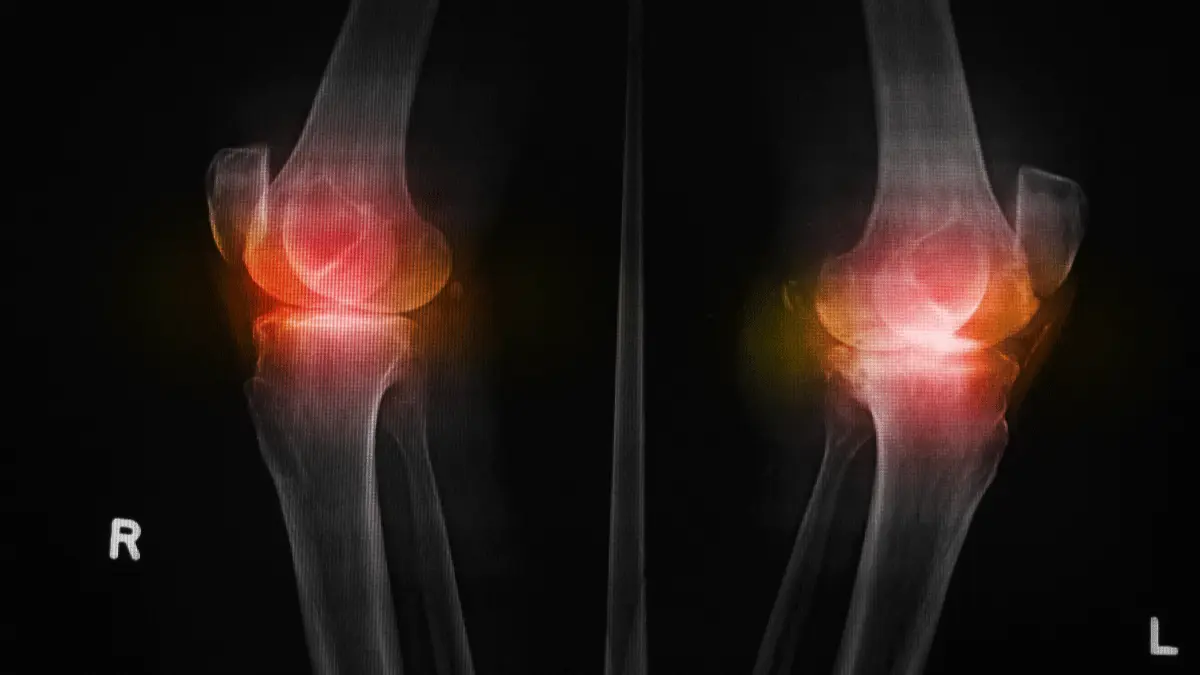 Osteófitos no joelho