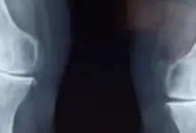 Redução do espaço articular femorotibial medial