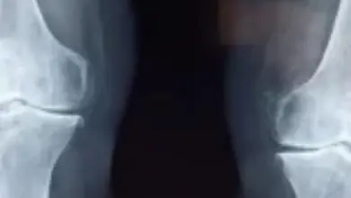 Redução do espaço articular femorotibial medial