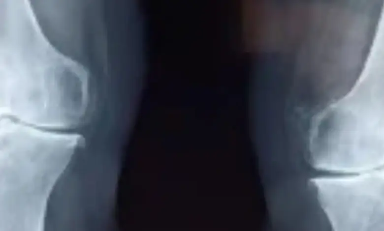 Redução do espaço articular femorotibial medial