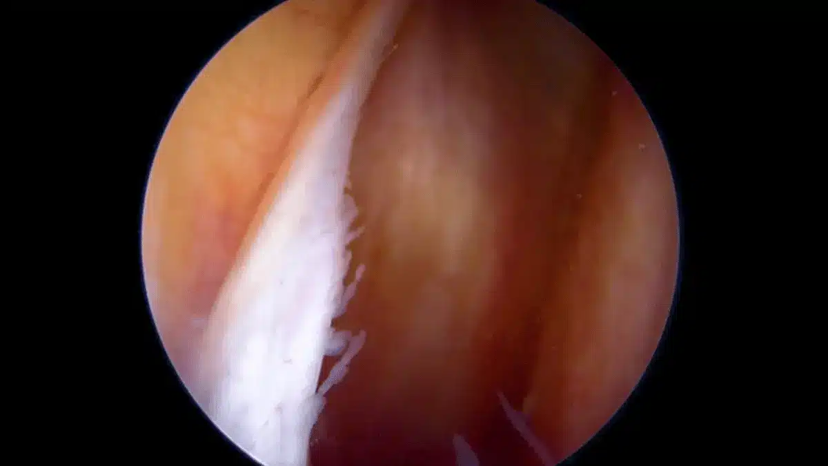 Sinovectomia no joelho