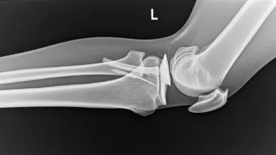 Avulsão tibial do LCP