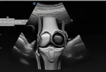 Bursopatia no joelho