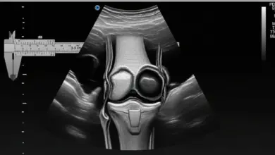 Bursopatia no joelho