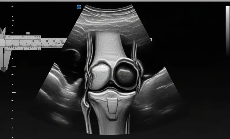Bursopatia no joelho