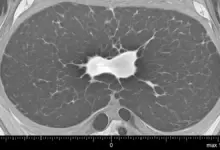 Edema focal do coxim adiposo