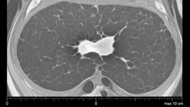 Edema focal do coxim adiposo