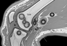 Gota tofácea do joelho