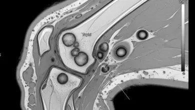 Gota tofácea do joelho