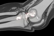 Lesão do ligamento colateral medial