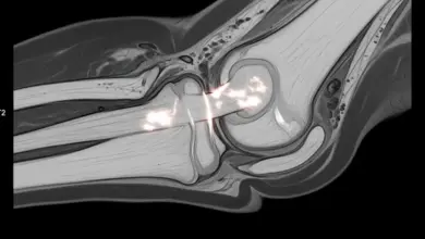 Lesão do ligamento colateral medial