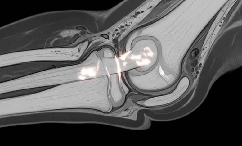 Lesão do ligamento colateral medial