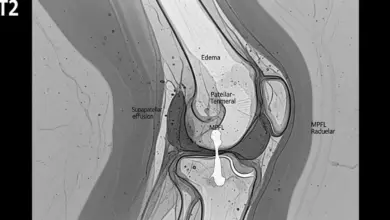 Luxação recidivante da patela