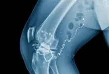 Osteomielite subaguda do joelho