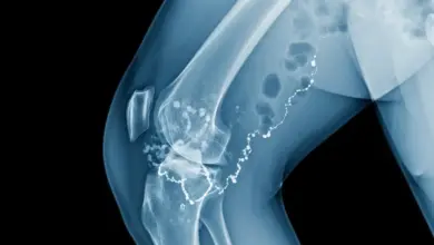 Osteomielite subaguda do joelho