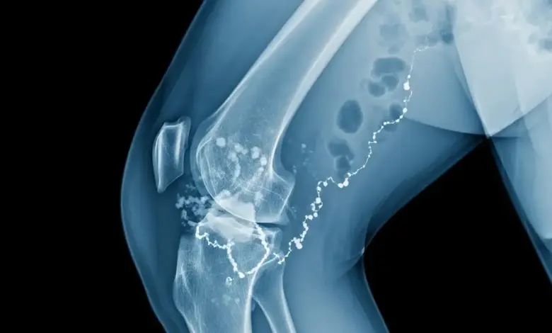 Osteomielite subaguda do joelho