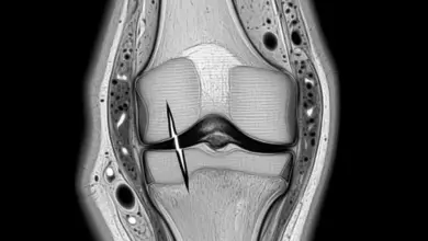 Qual pior tipo de lesão de menisco