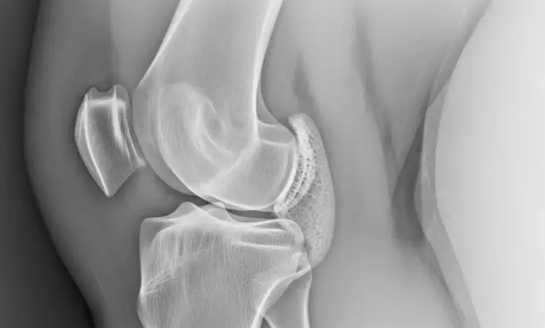 Síndrome de Pellegrini-Stieda