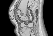 Artrofibrose no joelho
