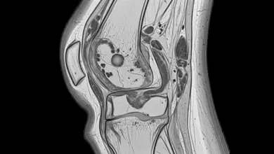 Artrofibrose no joelho