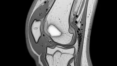 Lesão osteocondral da patela