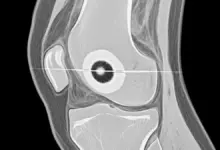Osteoma osteóide do joelho