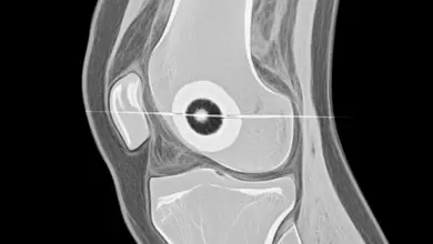 Osteoma osteóide do joelho