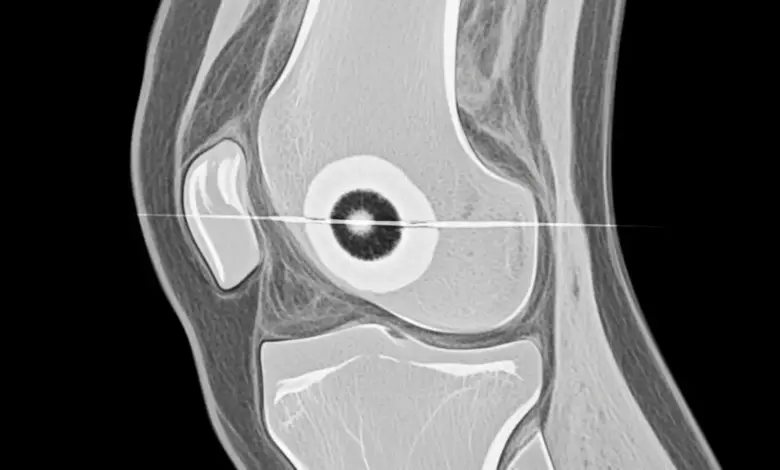 Osteoma osteóide do joelho
