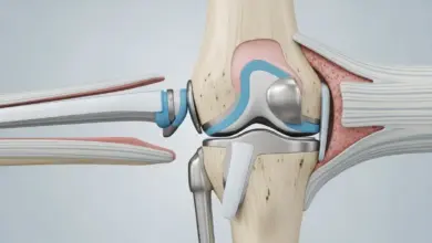 Prótese unicompartimental de joelho