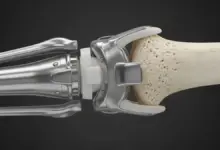 Quem tem prótese no joelho é considerado PCD