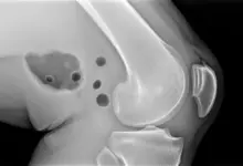 Artrose no joelho é perigoso