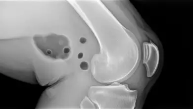 Artrose no joelho é perigoso