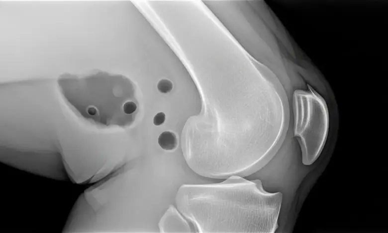 Artrose no joelho é perigoso