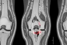 Cirurgia a laser LCA
