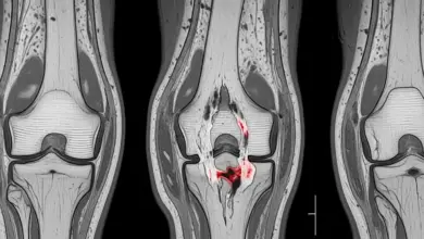 Cirurgia a laser LCA